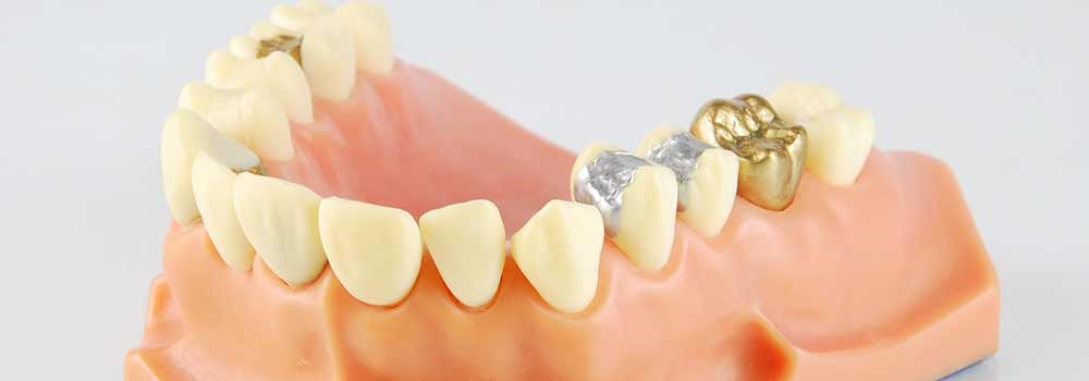 Cad Cam Dentures Cross City FL 32628